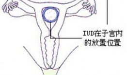 上节育环视频在线观看,在线观看科普视频解析